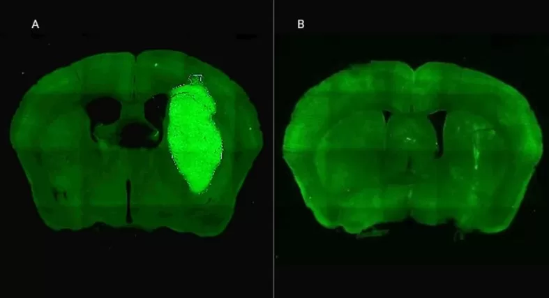 Lee más sobre el artículo Especialistas del CONICET lograron frenar un tipo de cáncer cerebral con una novedosa estrategia terapéutica