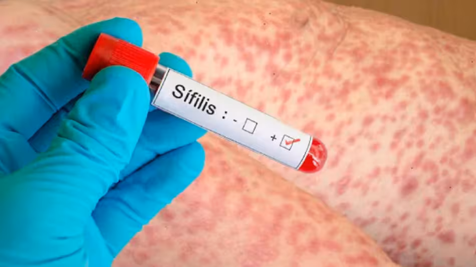 Lee más sobre el artículo Argentina registra el mayor número de casos de sífilis desde que existen registros