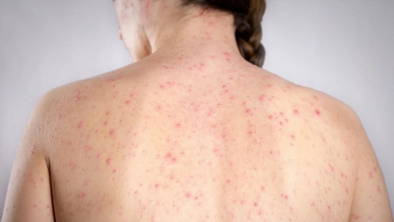 Lee más sobre el artículo Alerta epidemiológica por nuevos casos de sarampión