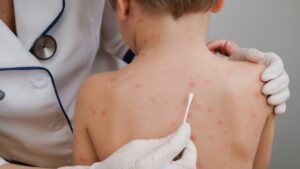 Lee más sobre el artículo Chile emite alerta epidemiológica por aumento de casos de sarampión en Argentina