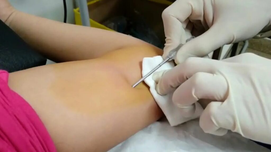 Río Negro distribuye implantes anticonceptivos de doble varilla
